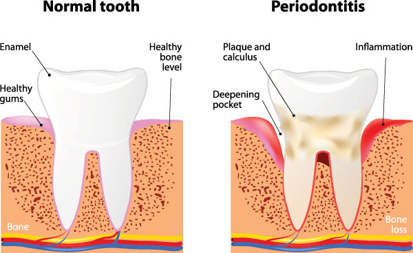 Periodontal Treatment in North Easton