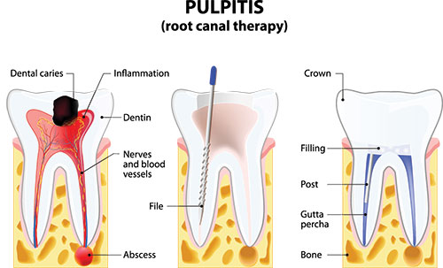 Root Canal in North Easton